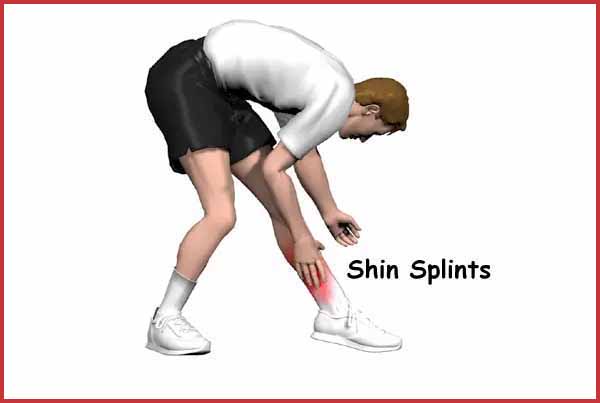 Shin Splint