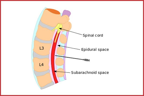 Epidural Technique