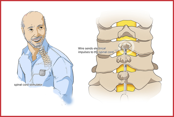 Spinal Cord Stimulators vs. Intrathecal Pumps for Chronic Back Pain