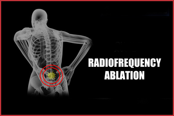 Radiofrequency Nerve Ablation RF