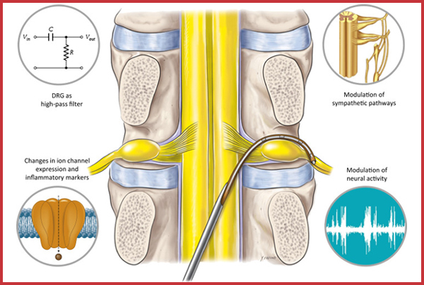 Dorsal Root Ganglion Stimulation